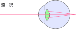 遠視の図
