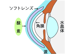 ソフトレンズ